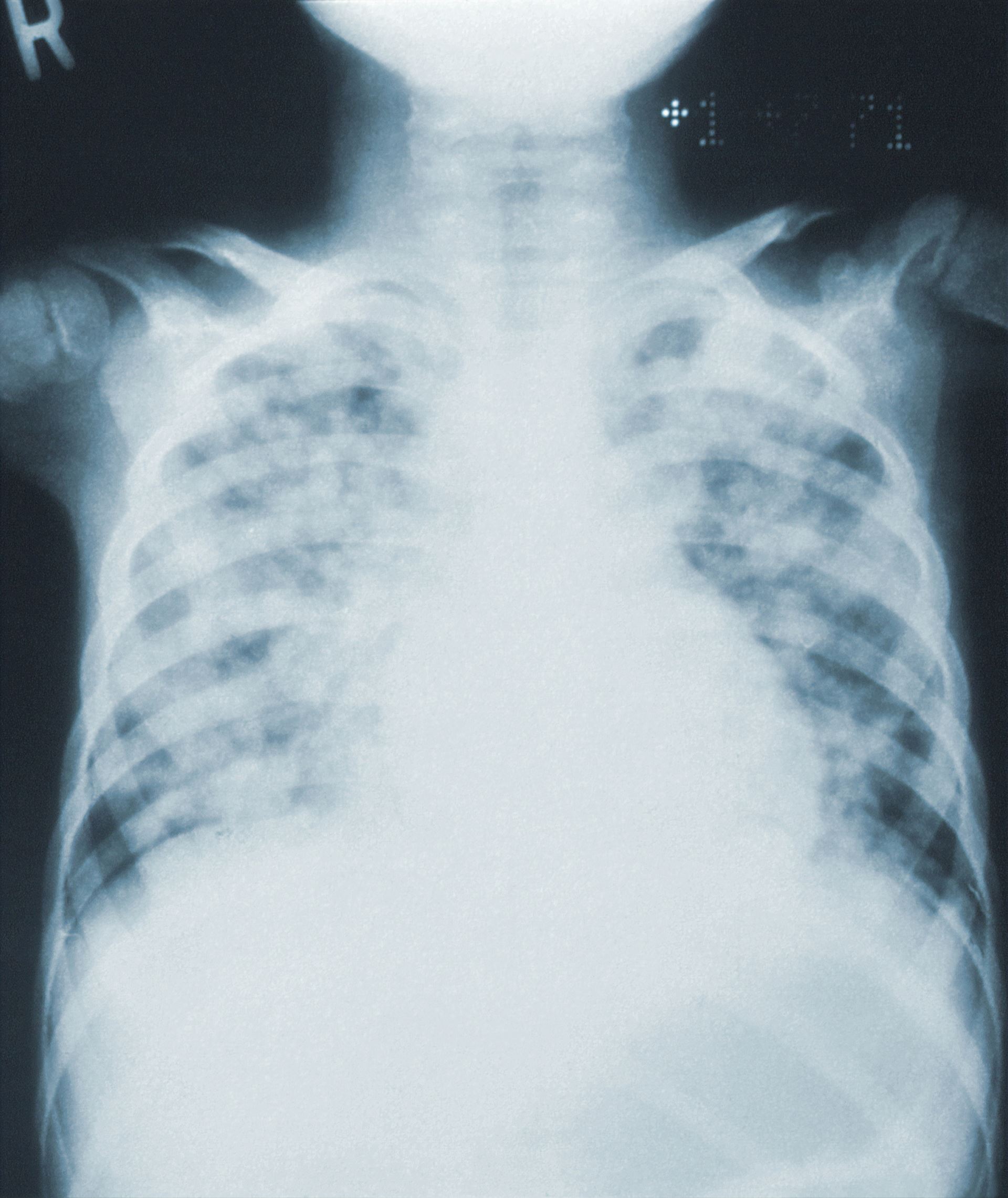 SPIROMETRY